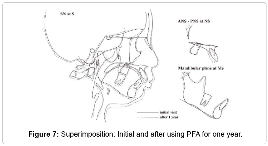 pediatric-dental-care-Superimposition