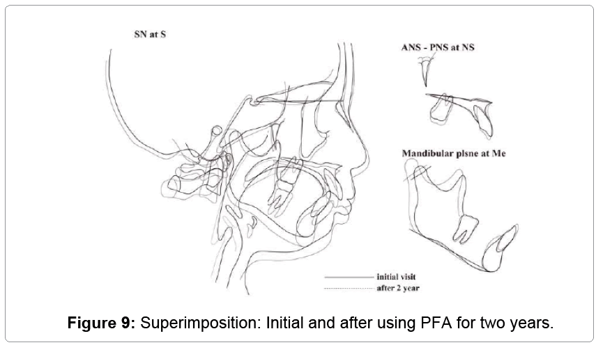 pediatric-dental-care-Superimposition