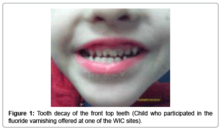 pediatric-dental-care-Tooth-decay