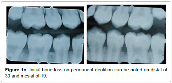 pediatric-dental-care-bone-loss-distal