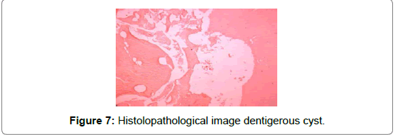 pediatric-dental-care-cyst