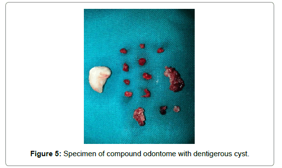 pediatric-dental-care-dentigerous