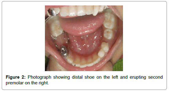 pediatric-dental-care-distal