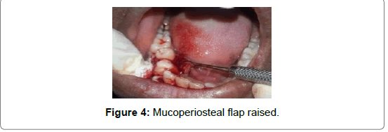 pediatric-dental-care-flap
