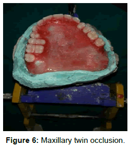 pediatric-dental-care-maxillary-twin-occlusion