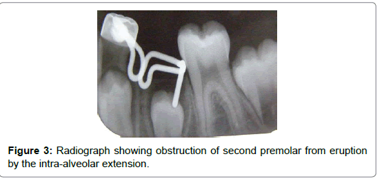 pediatric-dental-care-obstruction