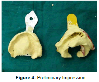 pediatric-dental-care-preliminary-impression