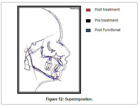 pediatric-dental-care-superimposition