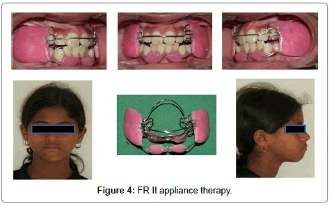 pediatric-dental-care-therapy
