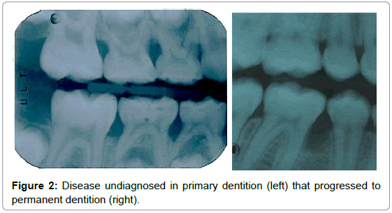pediatric-dental-care-undiagnosed-dentition-progressed