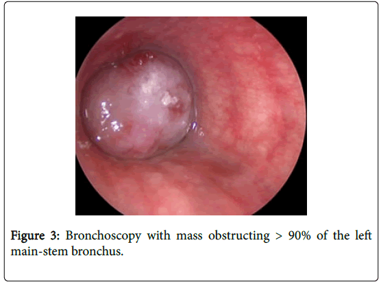 pediatric-medicine-bronchoscopy-with-mass-obstructing