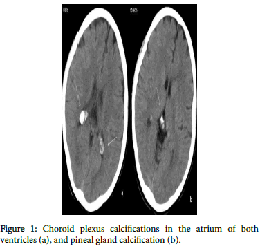 pediatric-neurological-disorders-Choroid-plexus-pineal
