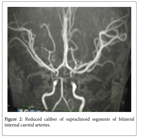 pediatric-neurological-disorders-bilateral