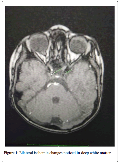 pediatric-neurological-disorders-ischemic