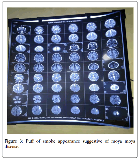 pediatric-neurological-disorders-suggestive