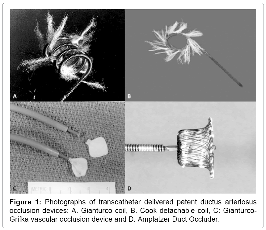 Transcatheter Closure of Patent Ductus Arteriosus OMICS International