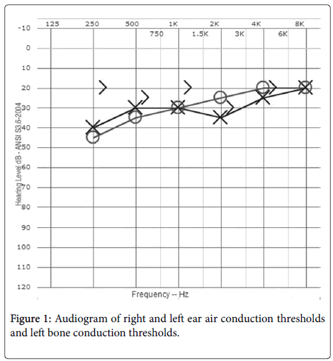 auditory neuropathy spectrum disorder in adults auditory neuropathy spectrum disorder in adults