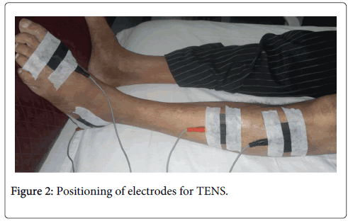 Tibialis Anterior Motor Point Chart