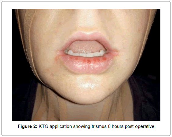 the clinical effectiveness of using kinesio tape following trismus