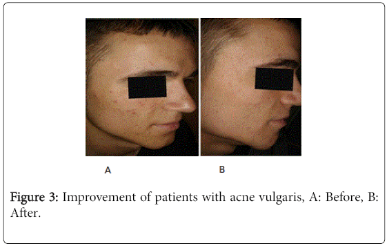 Articles about acne vulgaris