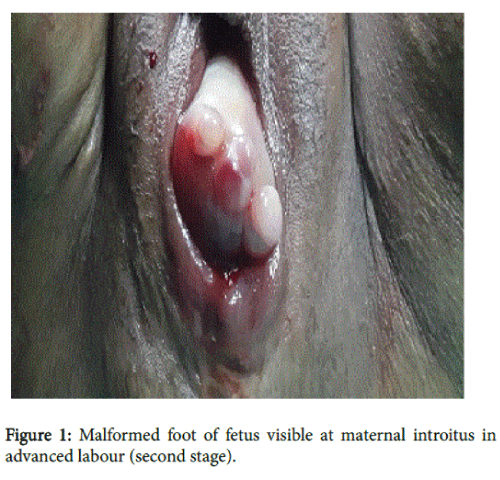 pregnancy-and-child-health-Malformed-foot