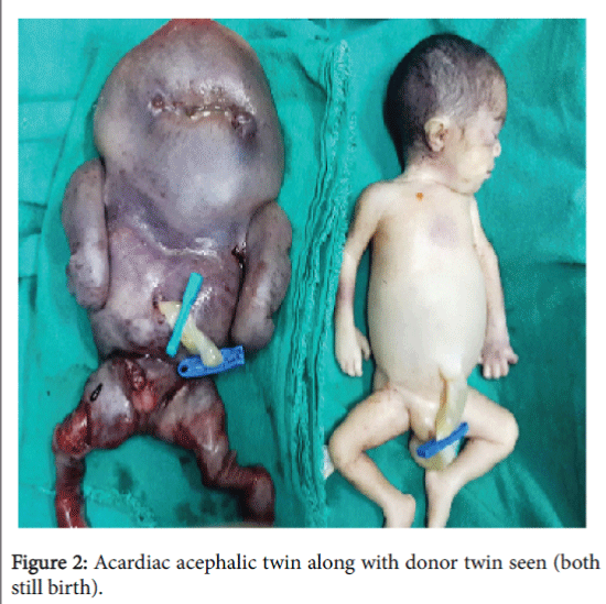 pregnancy-and-child-health-acardiac-acephalic