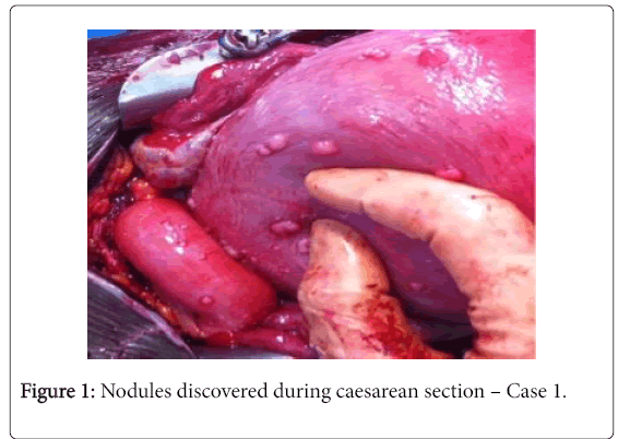 pregnancy-child-health-Nodules-discovered