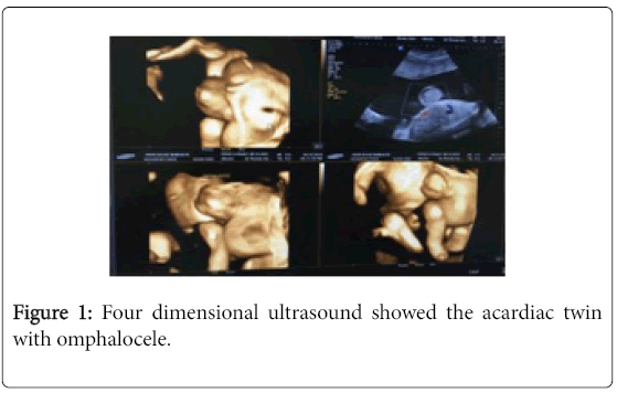 pregnancy-child-health-acardiac-twin