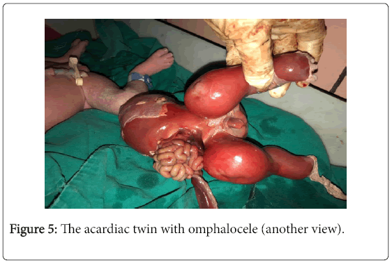 pregnancy-child-health-acardiac-twin