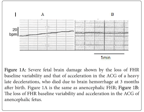 pregnancy-child-health-fetal-brain-damage