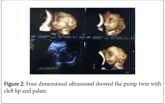 pregnancy-child-health-pump-twin
