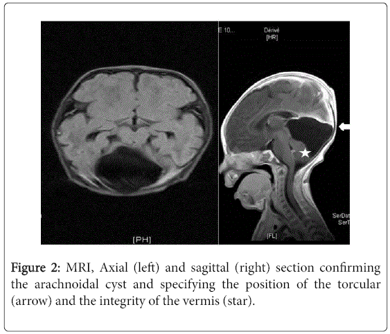 pregnancy-child-health-torcular