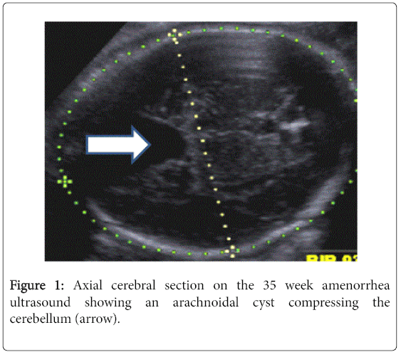 pregnancy-child-health-week-amenorrhea