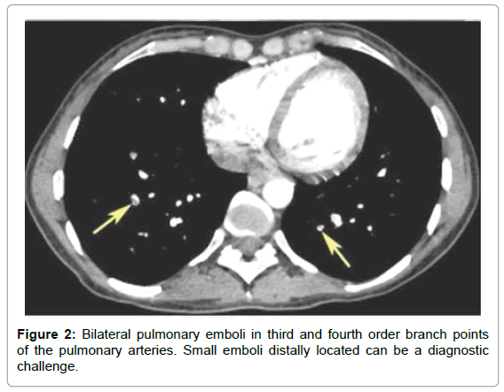 pulmonary respiratory small emboli distally pulmonary respiratory small emboli distally