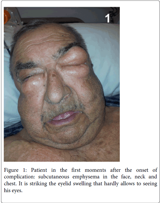facial swelling with copd Facial swelling with copd