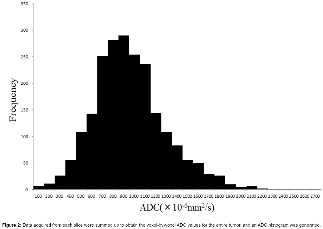 radiology-ADC-histogram-generated