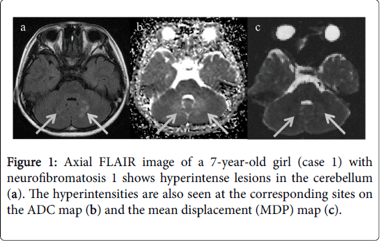 radiology-Axial-FLAIR-image