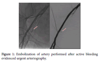 radiology-Embolization-artery-bleeding