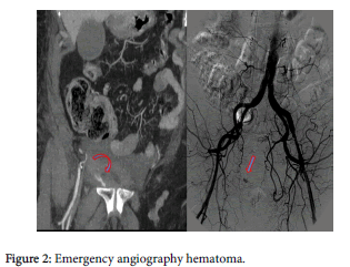radiology-Emergency-angiography-hematoma