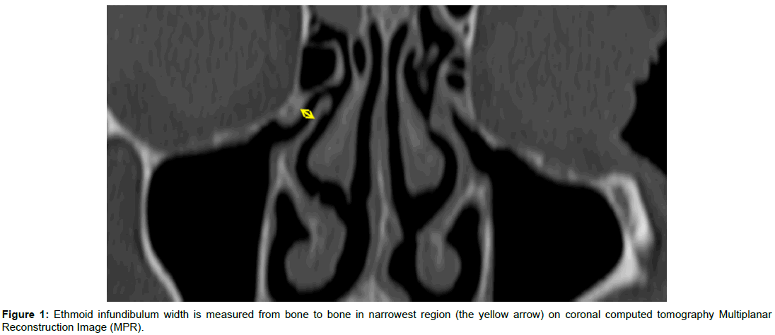 radiology-Ethmoid-infundibulum