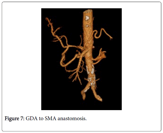radiology-SMA-anastomosis