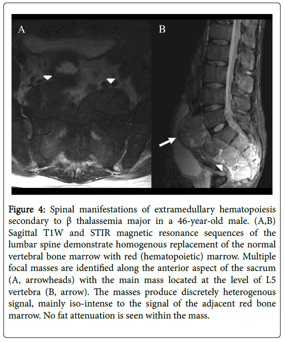radiology-Spinal-manifestations-extramedullary