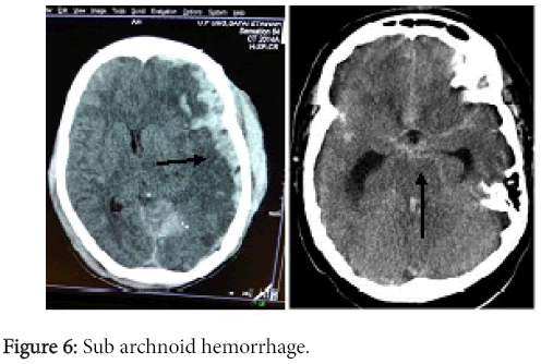 radiology-Sub-archnoid-hemorrhage