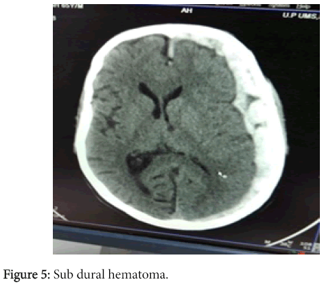 radiology-Sub-dural-hematoma