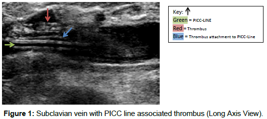 radiology-Subclavian-vein-PICC