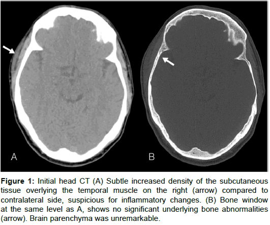 radiology-Subtle-increased-density