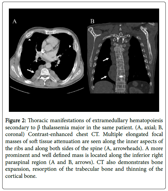 radiology-Thoracic-manifestations-extramedullary