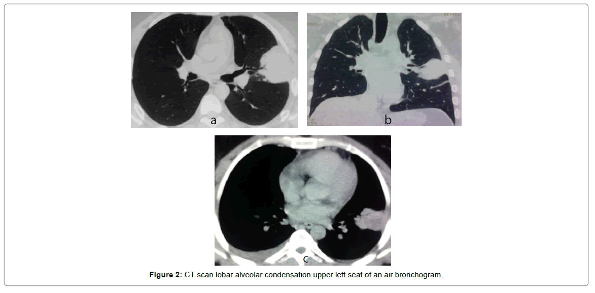 radiology-alveolar-condensation