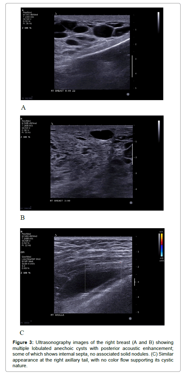 radiology-axillary-tail