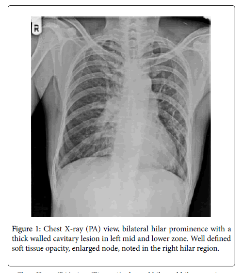 radiology-bilateral-hilar-prominence